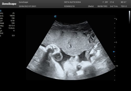 ULTRAZVUKOVÉ FOTOGRAFIE STELLINKY V PRŮBĚHU TĚHOTENSTVÍ
