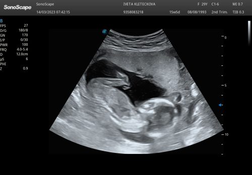 ULTRAZVUKOVÉ FOTOGRAFIE STELLINKY V PRŮBĚHU TĚHOTENSTVÍ